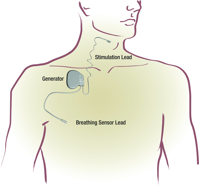 Inspire Therapy Device Illustration