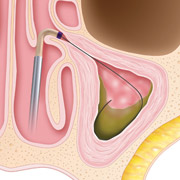 Balloon Sinuplasty - Step 1