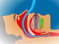 somnogaurd for snoring